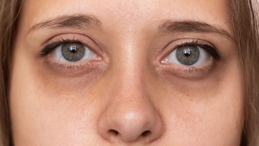 how-to-completely-get-rid-of-dark-circles-under-the-eyes-at-home