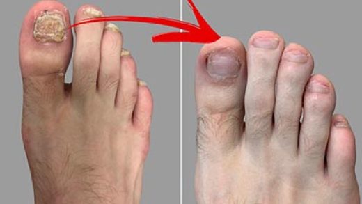 here-are-three-straightforward-methods-for-effectively-removing-fungus-from-toenails